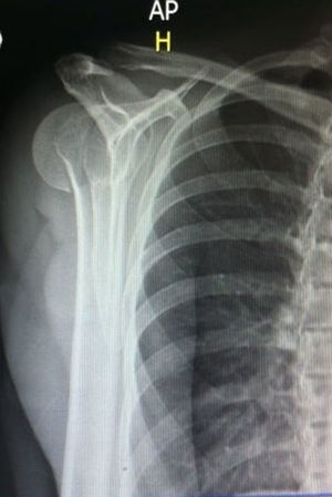 Radiografía anterioposterior (AP) verdadera de hombro (H), donde se observa el signo del bombillo (lightbulb sign) sugestivo de luxofractura posterior de hombro.