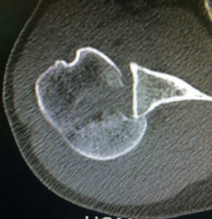 Radiografía lateral de escápula, donde se observa luxofractura posterior de hombro. Obsérvese la articulación glenohumeral vacía.