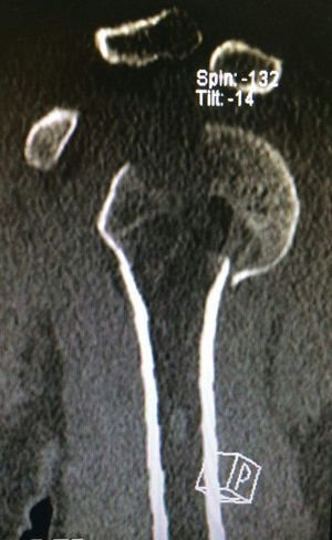 Corte axial de tomografía computarizada. Fractura impactada de cabeza humeral de tipo Hill-Sachs reversa.