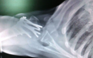 Radiografía AP verdadera de hombro con fractura reducida y material de osteosíntesis estable.