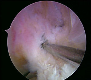 Reconstrucción anatómica del ligamento cruzado anterior - identificación del centro de la huella femoral.
