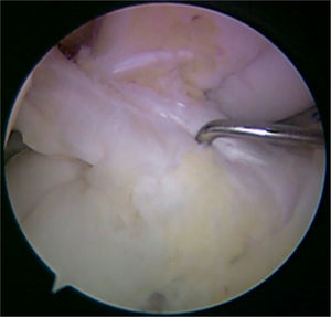 Reconstrucción anatómica del ligamento cruzado anterior - identificación de la huella tibial.