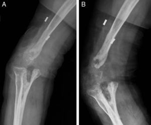Defecto óseo ulnohumeral posterior a resección local de tumor en húmero distal derecho y múltiples intervenciones quirúrgicas. Proyección anteroposterior (A) y lateral (B) de codo derecho.