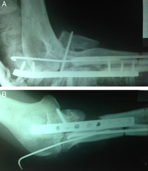 Osteosíntesis inicial realizada con placa y pines intramedulares. Proyección lateral (A) y anteroposterior (B) de codo izquierdo.