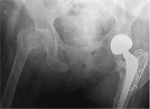 Paciente de 97 años de edad con fractura intertrocantérica de cadera derecha y antecedente de fractura de cadera izquierda.