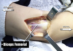 Disección del tendón del bíceps femoral. Liberación de la bandeleta isquiotibial.