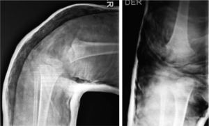 Radiografías de la rodilla derecha en el postoperatorio inmediato. Se visualiza a través del yeso la reducción anatómica de la luxación femorotibial.