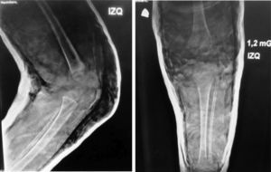 Radiografías de la rodilla izquierda en el postoperatorio inmediato. Se visualiza a través del yeso la reducción anatómica de la luxación femorotibial.