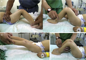 A-D) Imágenes del resultado postoperatorio de ambas rodillas. La rodilla derecha completa 2 meses de cirugía. La rodilla izquierda completa 1 mes de cirugía.
