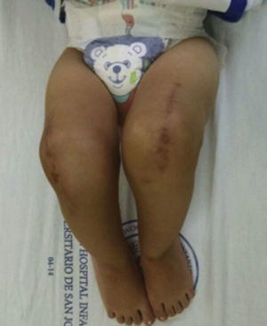 Movilidad de ambas rodillas en el seguimiento postoperatorio. Rodilla derecha: 5 meses. Rodilla izquierda: 4 meses.