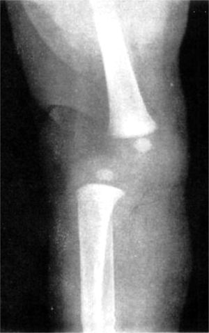 Radiografía en proyección lateral de una rodilla derecha con luxación congénita. Obsérvese la luxación femorotibial.