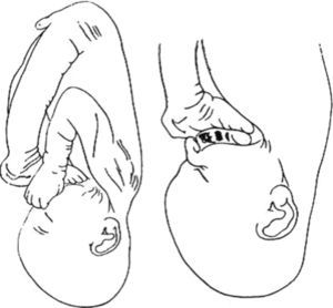 Posición intrauterina de un feto con luxación bilateral de rodillas, con los pies bloqueados en la mandíbula. Tomada de Niebauer JJ, King DE. Congenital Dislocation of the knee. J Bone Joint Surg Am. 1960;42:207-25.