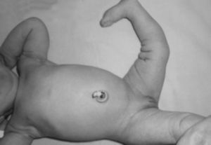 Aspecto clínico de las dos rodillas en un recién nacido con LCR bilateral.