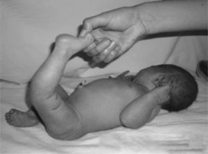 Aspecto clínico de la rodilla izquierda en un recién nacido con LCR unilateral. Además, se aprecia pie equinovaro derecho.