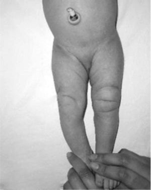 Aspecto clínico de las dos rodillas en un recién nacido con LCR bilateral. Obsérvense los pliegues y surcos transversos de la piel.