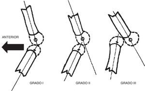 Grados de luxación congénita de la rodilla mediante radiografía lateral. Tomada de Jacobsen K, Vopalecky F. Congenital dislocation of the knee. Acta Orthop Scand. 1985;56:1-7.