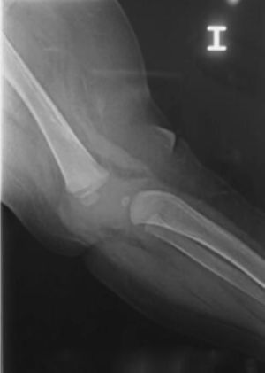Radiografía lateral de rodilla izquierda con LCR. Obsérvese la subluxación anterior de la tibia.