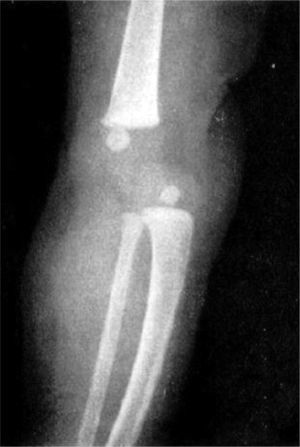 Radiografía en proyección lateral de una rodilla izquierda con luxación congénita. Obsérvese la luxación femorotibial.