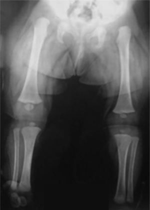 Radiografía anteroposterior de rodillas con LCR bilateral. Presenta, además, luxación bilateral de caderas.