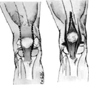 Técnica de Curtis y Fisher para la LCR. A) Líneas de incisión para la liberación de la cápsula anterior en sentido interno y externo, así como la liberación interna y externa del aparato extensor. B) Corrección después de la liberación de las partes blandas y del alargamiento del músculo recto femoral. Tomado de Bell MJ, Atkins RM, Sharrard WJ. Irreductible congenital dislocation of the knee: Aetiology and management. J Bone Joint Surg Br. 1987;69:403-6.