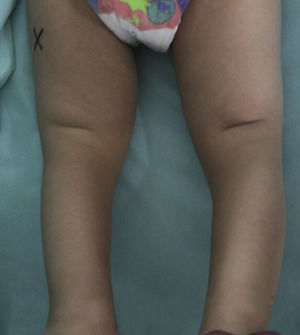 Valoración clínica de niño de 2 años con luxación congénita de la rodilla bilateral. Obsérvense los pliegues transversos anteriores en ambas rodillas.