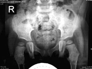 Radiografía de las caderas. Relaciones articulares normales sin evidencia de displasia de la cadera en desarrollo.