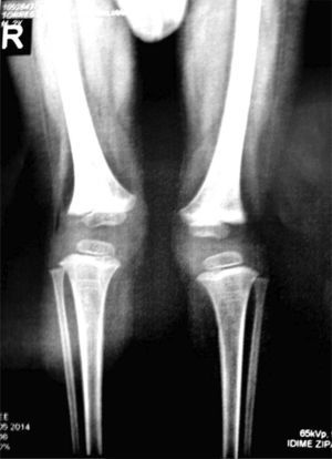 Radiografía anteroposterior de las rodillas.
