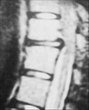 Corte sagital de resonancia magnética ampliado en nivel T11.