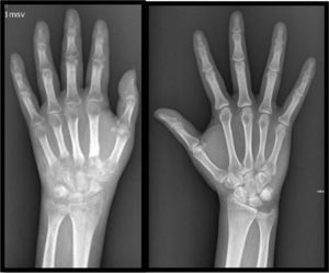 Radiografía de mano anteroposterior derecha e izquierda. Osteopenia yuxtaarticular y de los huesos del carpo, donde se asocia con erosiones subcondrales, y disminución de la amplitud del espacio articular. Edema de tejidos blandos adyacentes al carpo. El lado izquierdo es normal.