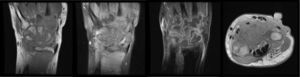 Resonancia magnética de mano derecha que muestra extensa sinovitis con múltiples erosiones de la base de los metacarpianos y las superficies articulares de los huesos del carpo. Aumento del líquido intraarticular. Obsérvese el realce de la sinovial después de la administración del medio de contraste.