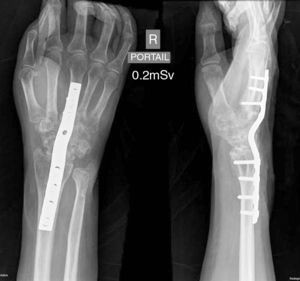Seis meses después se realiza artrodesis de la muñeca como consecuencia de las alteraciones articulares en los huesos del carpo.