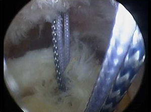 Colocación de ambos anclajes para iniciar el paso de suturas con sutura de tipo MAC anterior y posterior.