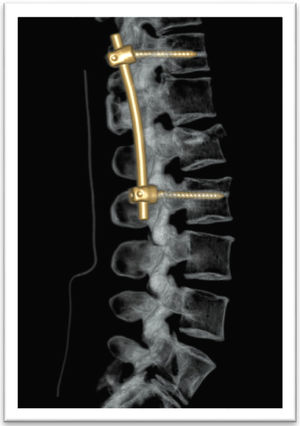 Tomografía computada reconstrucción lateral lumbosacra que muestra los resultados posoperados.