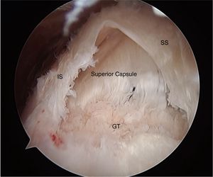 Visión sub-acromial mostrando la lesión delaminada del manguito rotador. IS: Infraspinatus; SS: Supraspinatus; GT: Tuberosidad mayor.