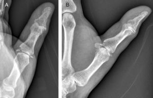 Estudio radiográfico del pulgar donde se muestra la avulsión ósea de ambos ligamentos colaterales de la articulación metacarpofalángica del pulgar. A) Proyección anteroposterior. B) Proyección lateral.