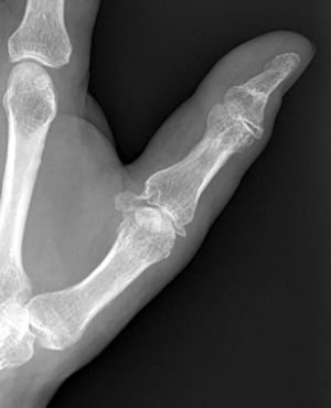 Proyección radiográfica anteroposterior de la articulación metacarpofalángica del pulgar, 12 meses más tarde. Obsérvese la falta de unión de ambas avulsiones óseas.