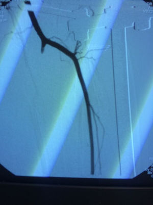 Lesión vascular del tronco tibioperoneo diagnosticada por arteriografía.