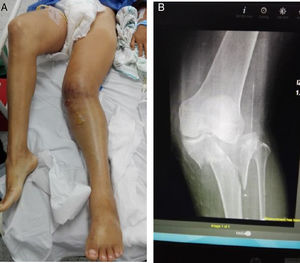 A) Luxación de rodilla. B) Radiografía.