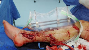 Puente femorodistal en paciente con lesión vascular.