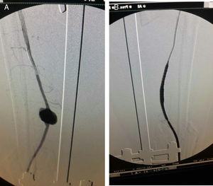 A) Pseudoaneurisma de arteria tibial anterior. B) Manejo intravascular con stent cubierto.