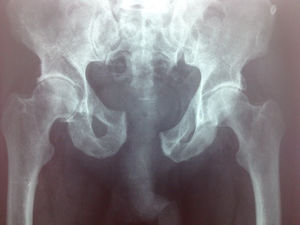 Imagen radiográfica a la llegada del paciente a Urgencias, en la cual se aprecia la fractura de pelvis de tipo C1-C2 de Tile.