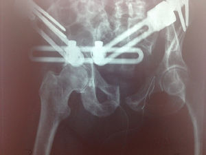 Imagen radiográfica tras la colocación del fijador externo en la cirugía de urgencia.