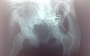 Imagen radiográfica tras la osteosíntesis definitiva.
