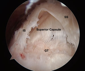 Subacromial view showing the delaminated lesion of the rotator cuff. IS: Infraspinatus; SS: Supraspinatus; GT: Greater tuberosity.