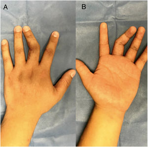 Deformidad articular e incapacidad funcional para la flexión de articulación IFP de tercer dedo mano izquierda. A. Dorsal, B. Volar.
