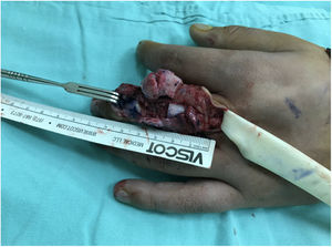 Osteotomías transdiafisarias de falange proximal y media.