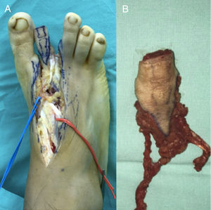 A. Disección y procuración de articulación interfalángica proximal de 2° dedo del pie derecho. B. Pedículo neurovascular medial y prolongación hasta arteria pedia así como de venas dorsales concomitantes metatarsianas.