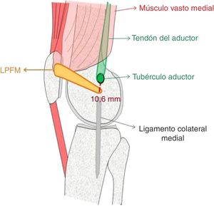 Puntos anatómicos de inserción LPFM.