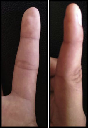 2̊ dedo de la mano afectada.
