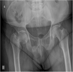 Radiografía PA: Fractura subcapital de fémur derecho.
